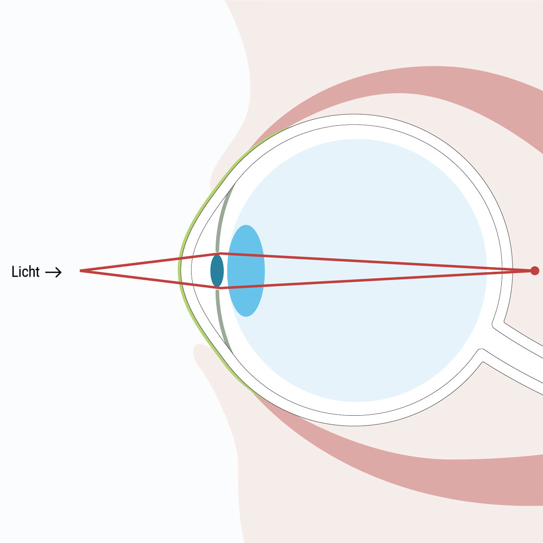 Bei der Altersweitsichtigkeit können mit zunehmenden Alter Objekte in der Nähe nur mehr unscharf erkannt werden - Augenlasern Wien, Dr. Atamniy