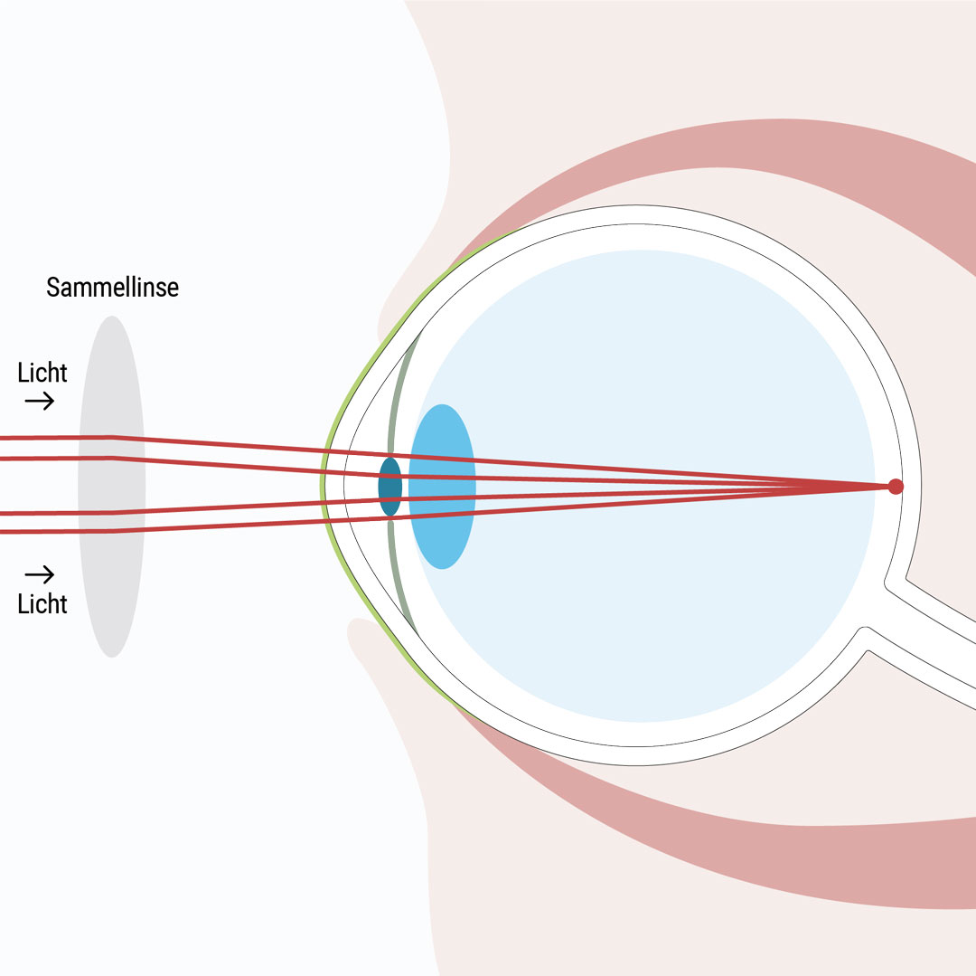 Altersweitsichtigkeit mithilfe von Kontaktlinsen, einer passenden Brille oder mittels Augenlaser Methoden korrigieren - Augenlasern Wien, Dr. Atamniy