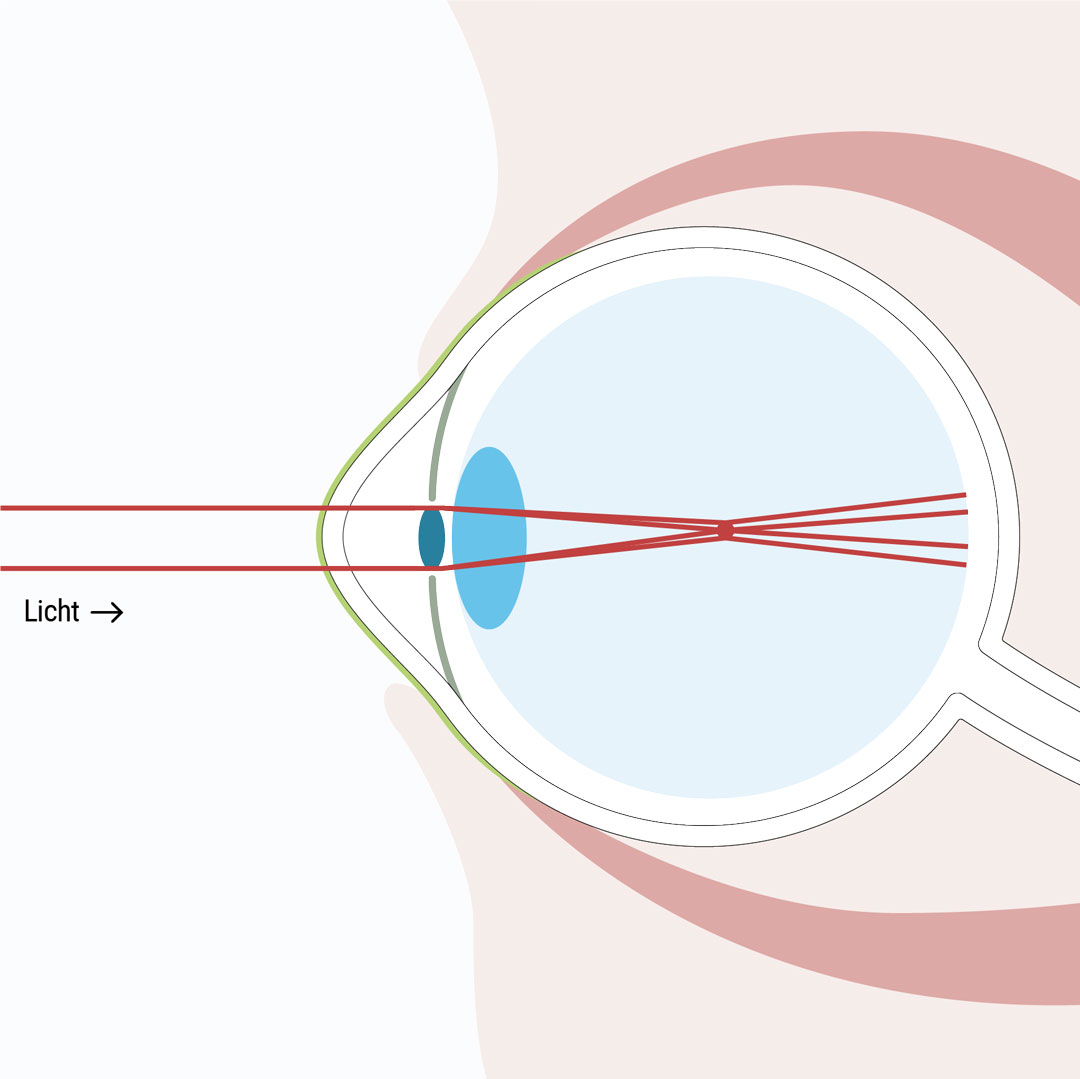 Bei der Hornhautverkrümmung sind Objekte in der Nähe und Ferne unscharf - Weitsichtigkeit mithilfe von Kontaktlinsen, einer passenden Brille oder mittels Augenlaser Methoden korrigieren - Augenlasern Wien, Dr. Atamniy