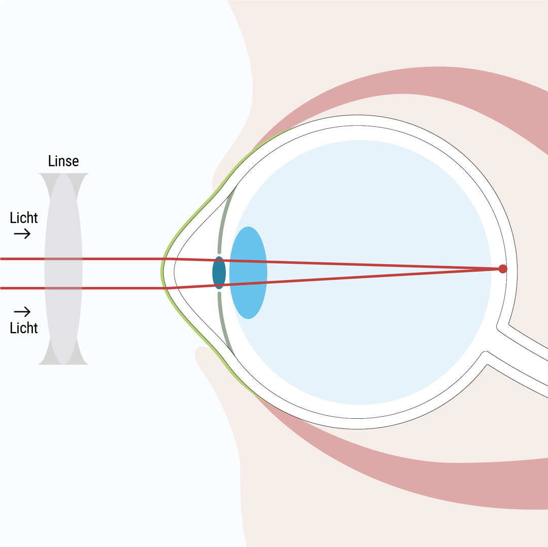 Hornhautverkrümmung mithilfe von Kontaktlinsen, einer passenden Brille oder mittels Augenlaser Methoden korrigieren - Augenlasern Wien, Dr. Atamniy