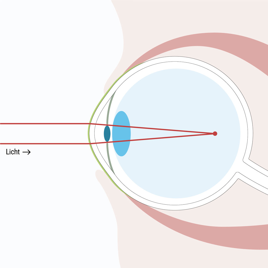 Kurzsichtigkeit ist eine optische Fehlsichtigkeit bei der weiter entfernte Objekte unscharf werden - Weitsichtigkeit ist eine optische Fehlsichtigkeit bei der naheliegende Objekte unscharf wahrgenommen werden - Augenlasern Wien, Dr. Atamniy