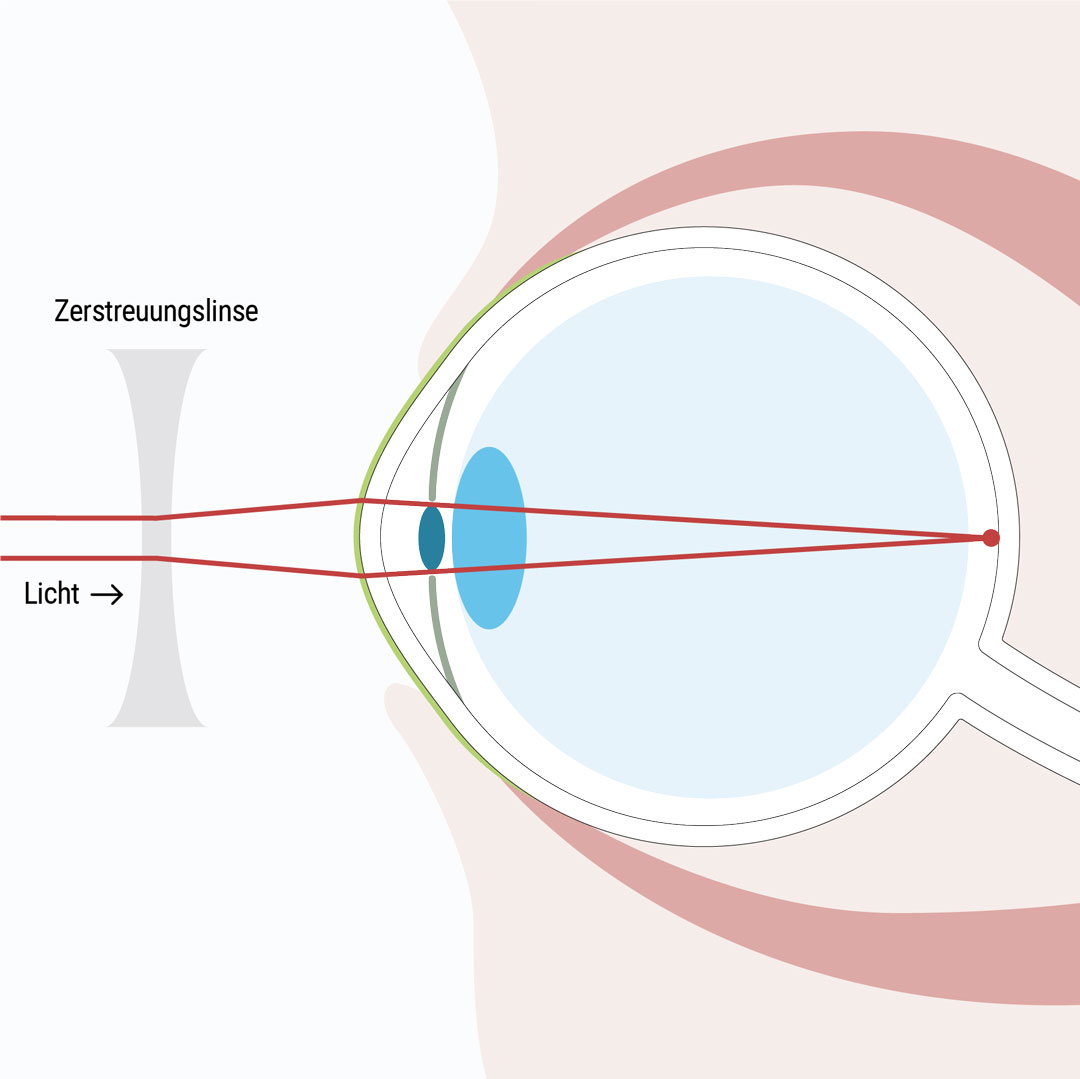 Kurzsichtigkeit kann man zum Beispiel mithilfe von Kontaktlinsen, einer passenden Brille oder einer Augenlaser Behandlung korrigiert werden - Weitsichtigkeit mithilfe von Kontaktlinsen, einer passenden Brille oder mittels Augenlaser Methoden korrigieren - Augenlasern Wien, Dr. Atamniy