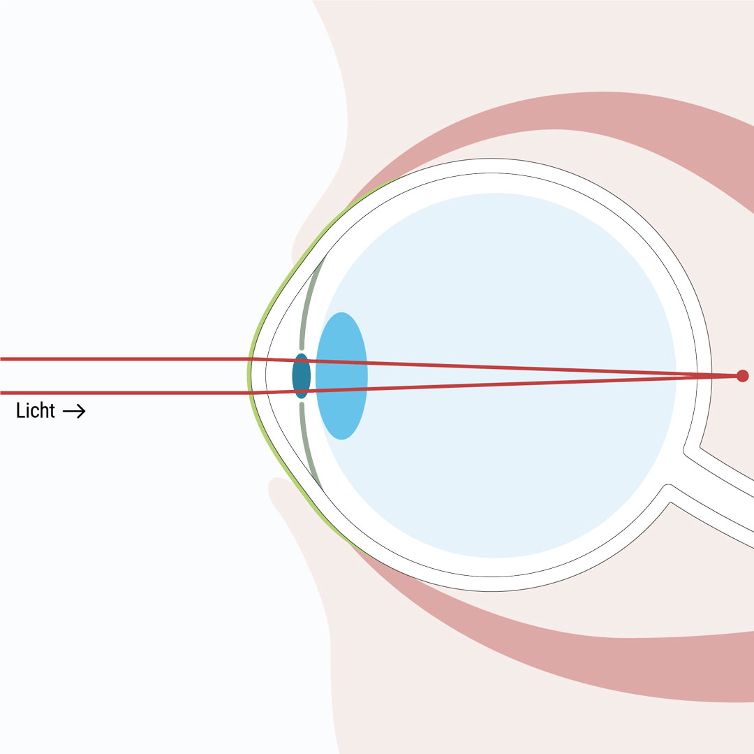 Weitsichtigkeit ist eine optische Fehlsichtigkeit bei der naheliegende Objekte unscharf wahrgenommen werden - Augenlasern Wien, Dr. Atamniy