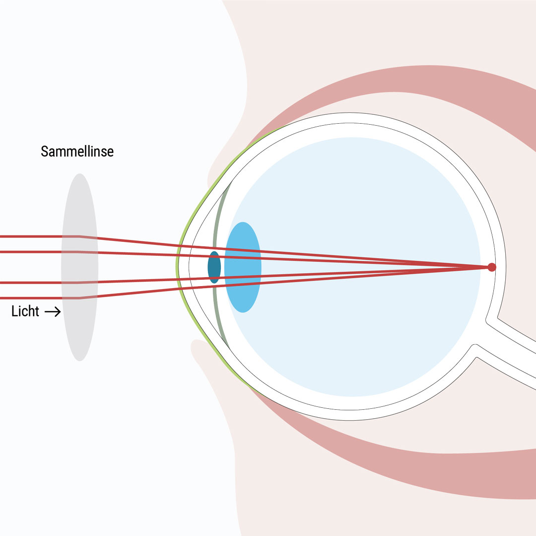 Weitsichtigkeit mithilfe von Kontaktlinsen, einer passenden Brille oder mittels Augenlaser Methoden korrigieren - Augenlasern Wien, Dr. Atamniy