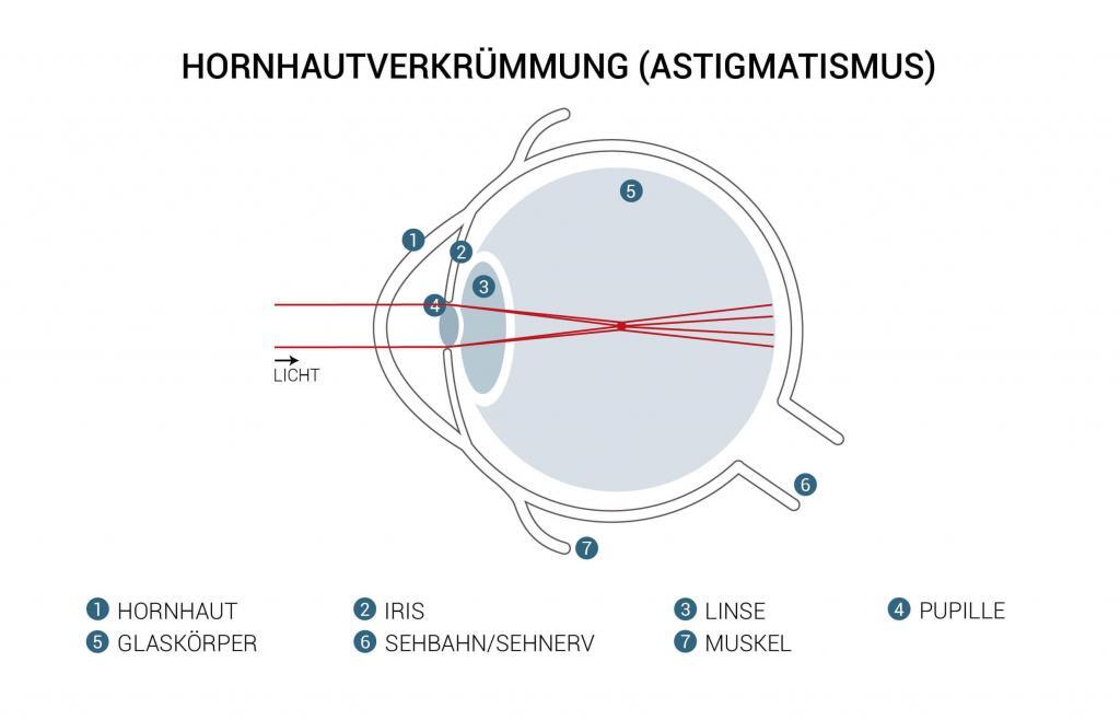 hornhautverkrümmung lasern lassern, Augenlasern Wien, Dr. jamale Atamniy, Augen lasern lasseen