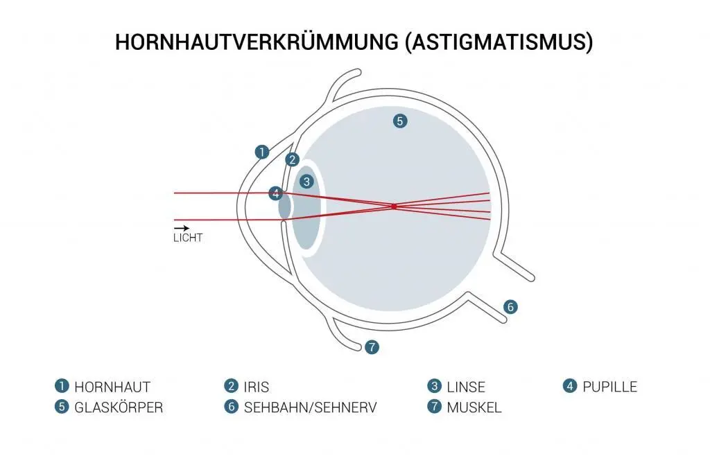 hornhautverkrümmung lasern lassern, Augenlasern Wien, Dr. jamale Atamniy, Augen lasern lasseen