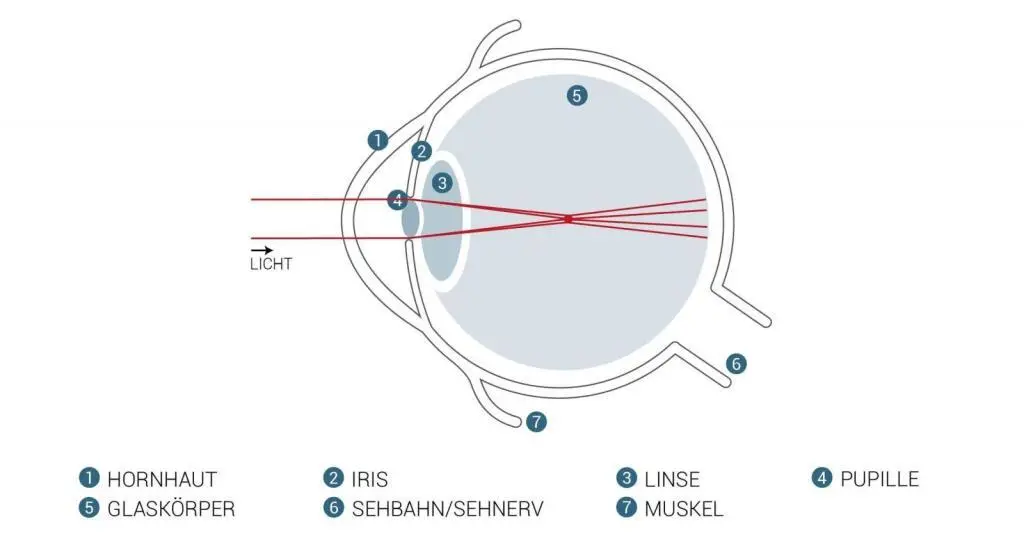 Hornhautverkrümmung lasern, Hornhautverkrümmung, kann man Hornhautverkrümmung lasern, Augenlasern Wien, Kurzsichtigkeit lasern